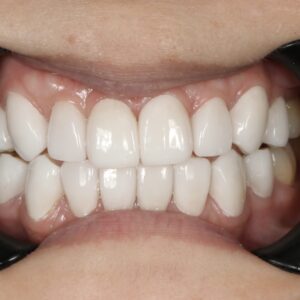 13after