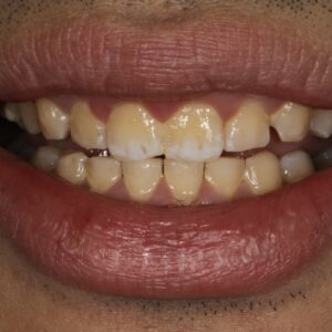 5before