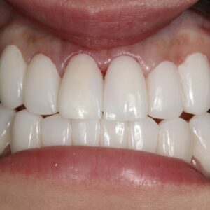71after