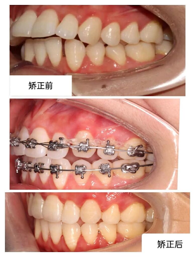 箍牙前後比較
