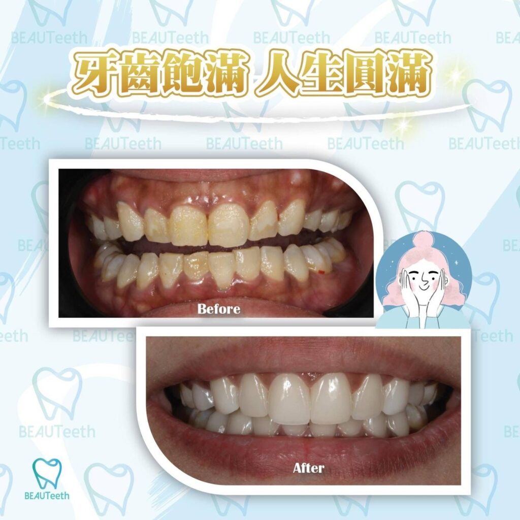 牙貼面案例